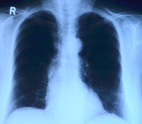la contaminación causa daños en los pulmones